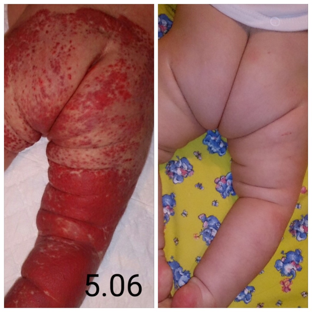 Результат лечения сегментарной младенческой гемангиомы атенололом.