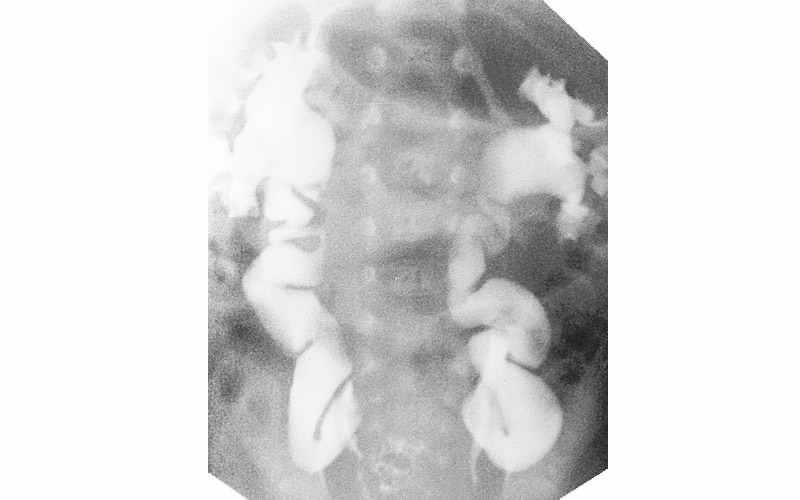 Мегауретер на рентгеновском снимке