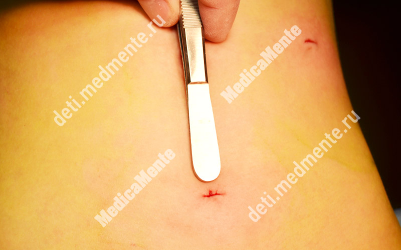 Швы после лапароскопического лечения паховой грыжи у девочки - размер ранок не более 5 мм (ширина инструмента 11 мм)
